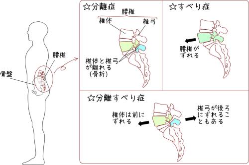 腰椎分離症・すべり症の図
