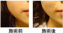 ほほのラインの変化