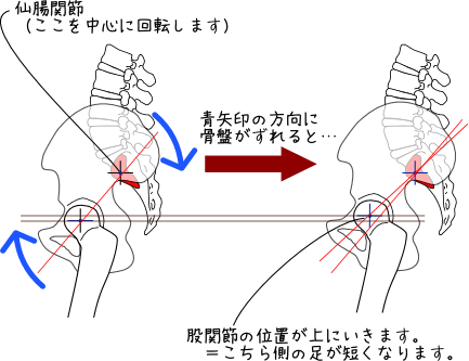 骨盤のズレと股関節の関係